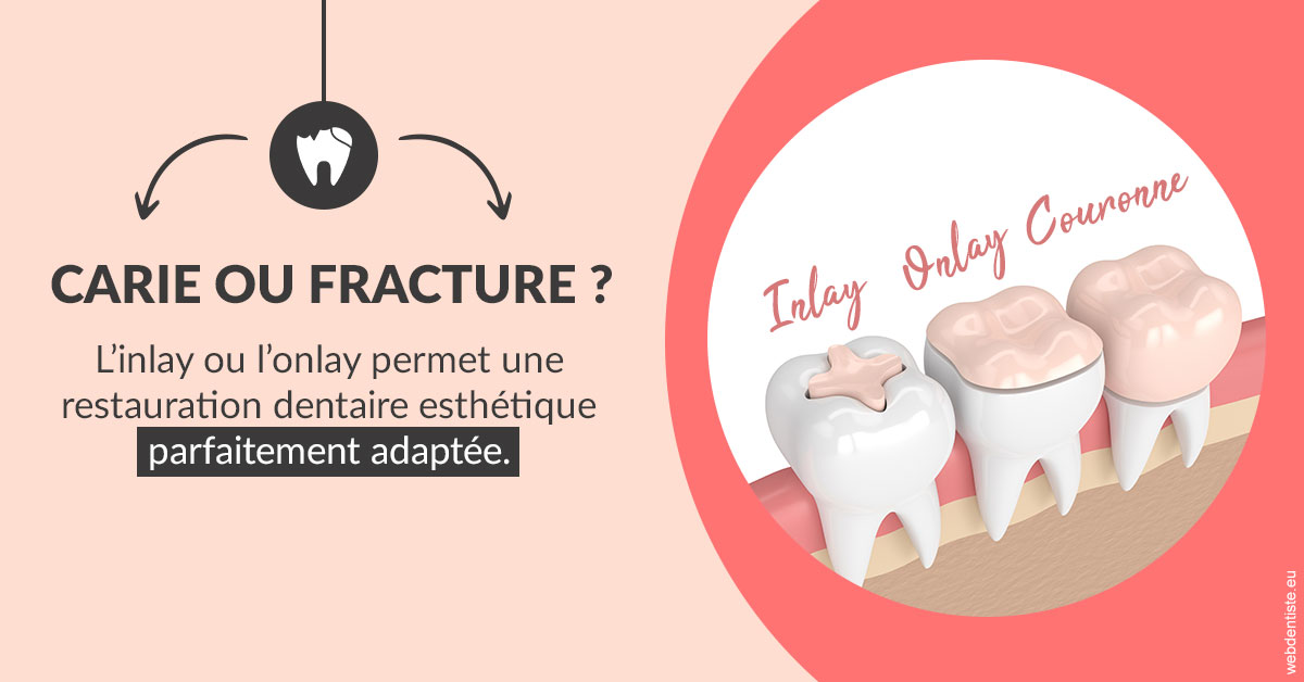 https://dr-anne-laure-pissavin.chirurgiens-dentistes.fr/T2 2023 - Carie ou fracture 2