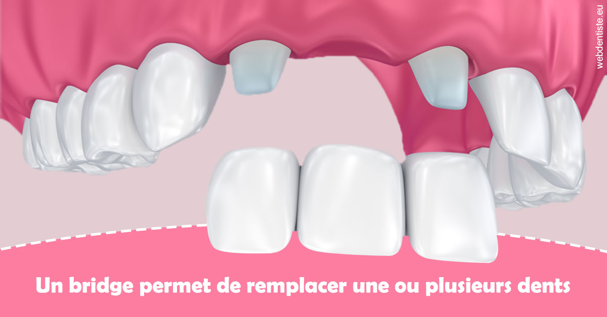 https://dr-anne-laure-pissavin.chirurgiens-dentistes.fr/Bridge remplacer dents 2