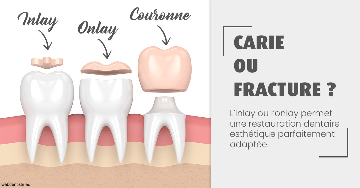 https://dr-anne-laure-pissavin.chirurgiens-dentistes.fr/T2 2023 - Carie ou fracture 1