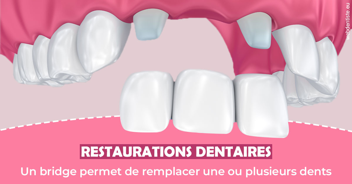 https://dr-anne-laure-pissavin.chirurgiens-dentistes.fr/Bridge remplacer dents 2