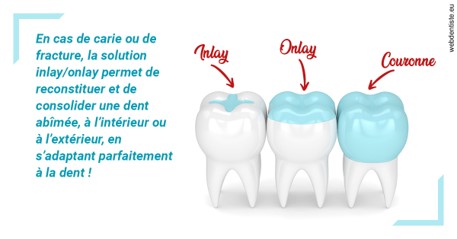 https://dr-anne-laure-pissavin.chirurgiens-dentistes.fr/L'INLAY ou l'ONLAY