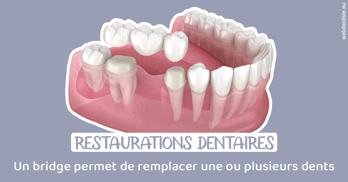 https://dr-anne-laure-pissavin.chirurgiens-dentistes.fr/Bridge remplacer dents 1