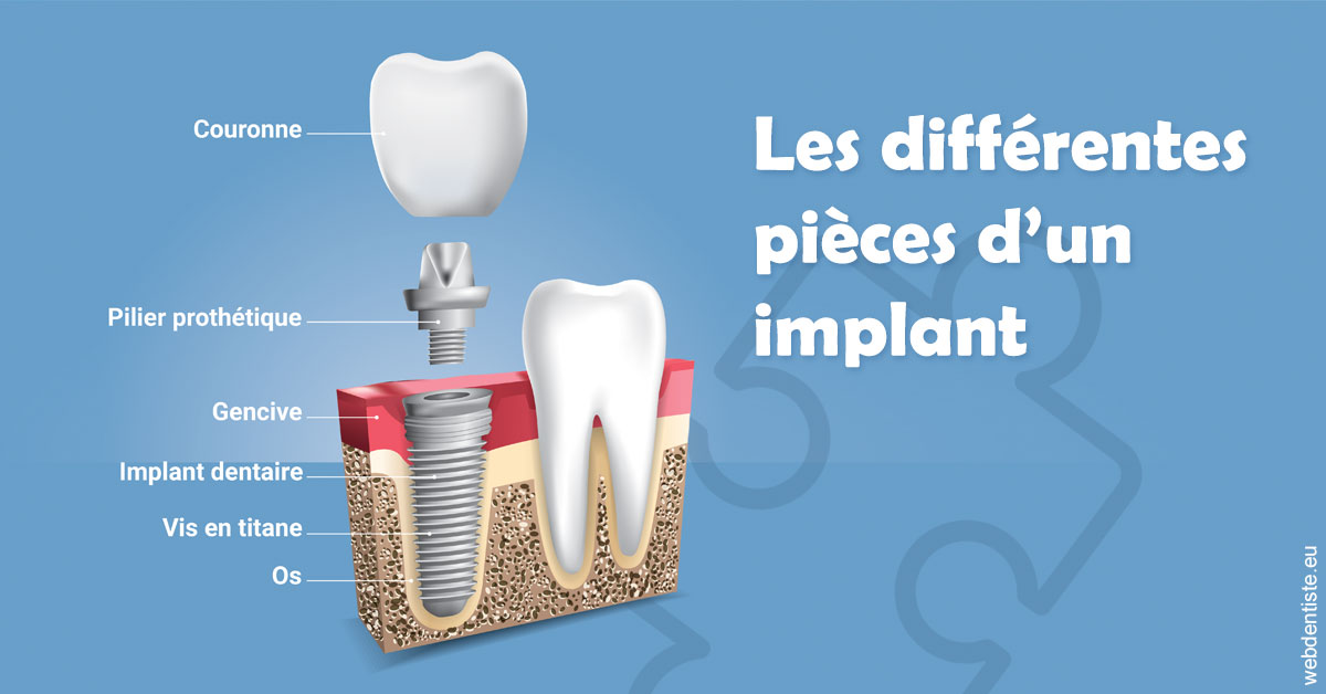 https://dr-anne-laure-pissavin.chirurgiens-dentistes.fr/Les différentes pièces d’un implant 1